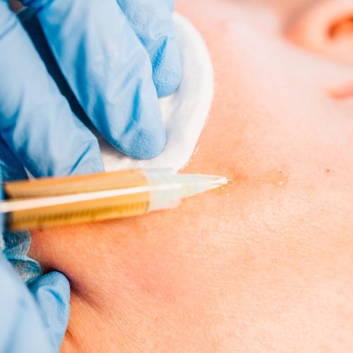 Plasma lifting - injections of blood plasma into the skin in the lower jaw area