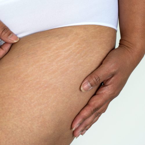 closeup stretch marks on woman buttocks, imperfect natural rough skin on Asian woman