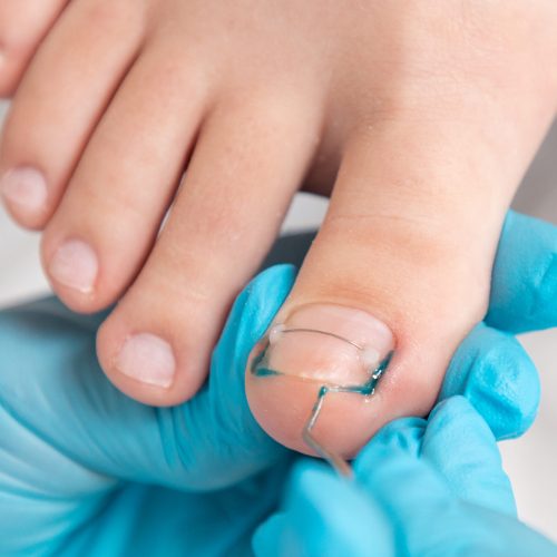 A podologist in blue gloves clean with curette a toenail with titanium thread. Close-up. Top view. The concept of podology and chiropody.