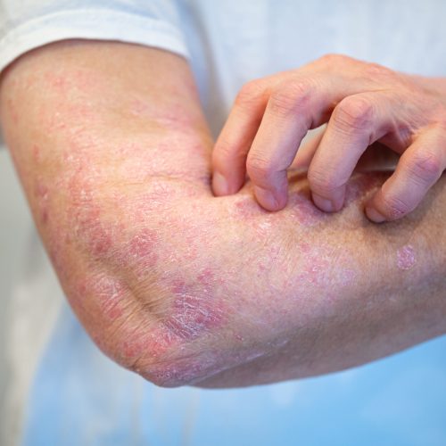 Itchy psoriasis on arm and hand