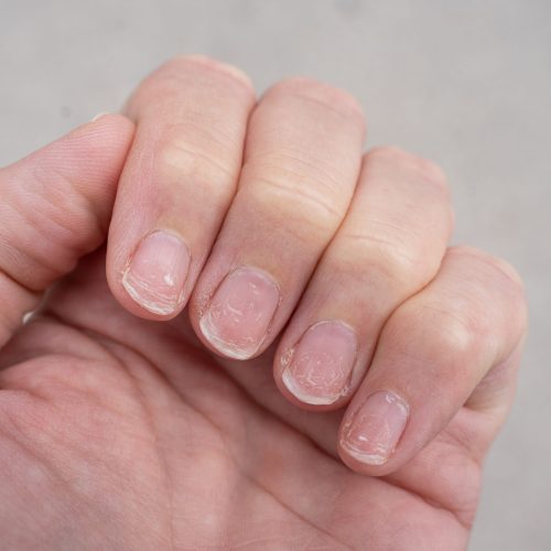 Regrown nail cuticle and damaged nail plate after gel polish. Flaky brittle nails without a manicure.