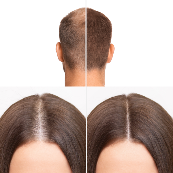 Montage Haarausfall Landingpage Studie Entwurf MANN FRAU